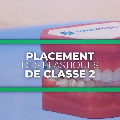 elastique classe ll au cabinet d'orthodontie du Dr Boes-Hulmann
