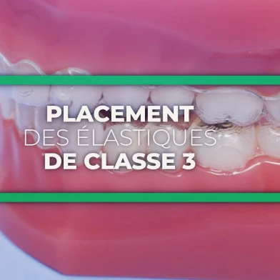 elastique classe lll au cabinet d'orthodontie du Dr Boes-Hulmann